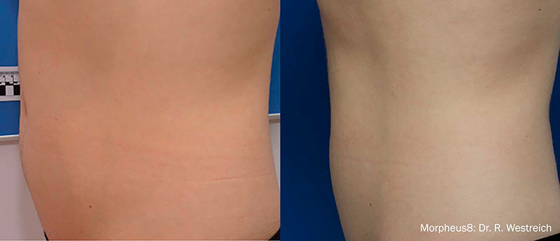 Antes e depois de Morpheus 8 no abdomen para gordura localizada