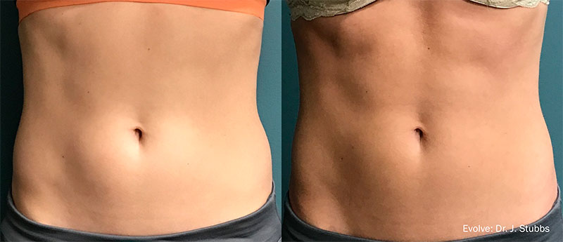 Antes e depois de tratamento no abdomen com Transform X