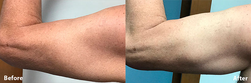 Antes e depois de tratamento no braço com Transform X