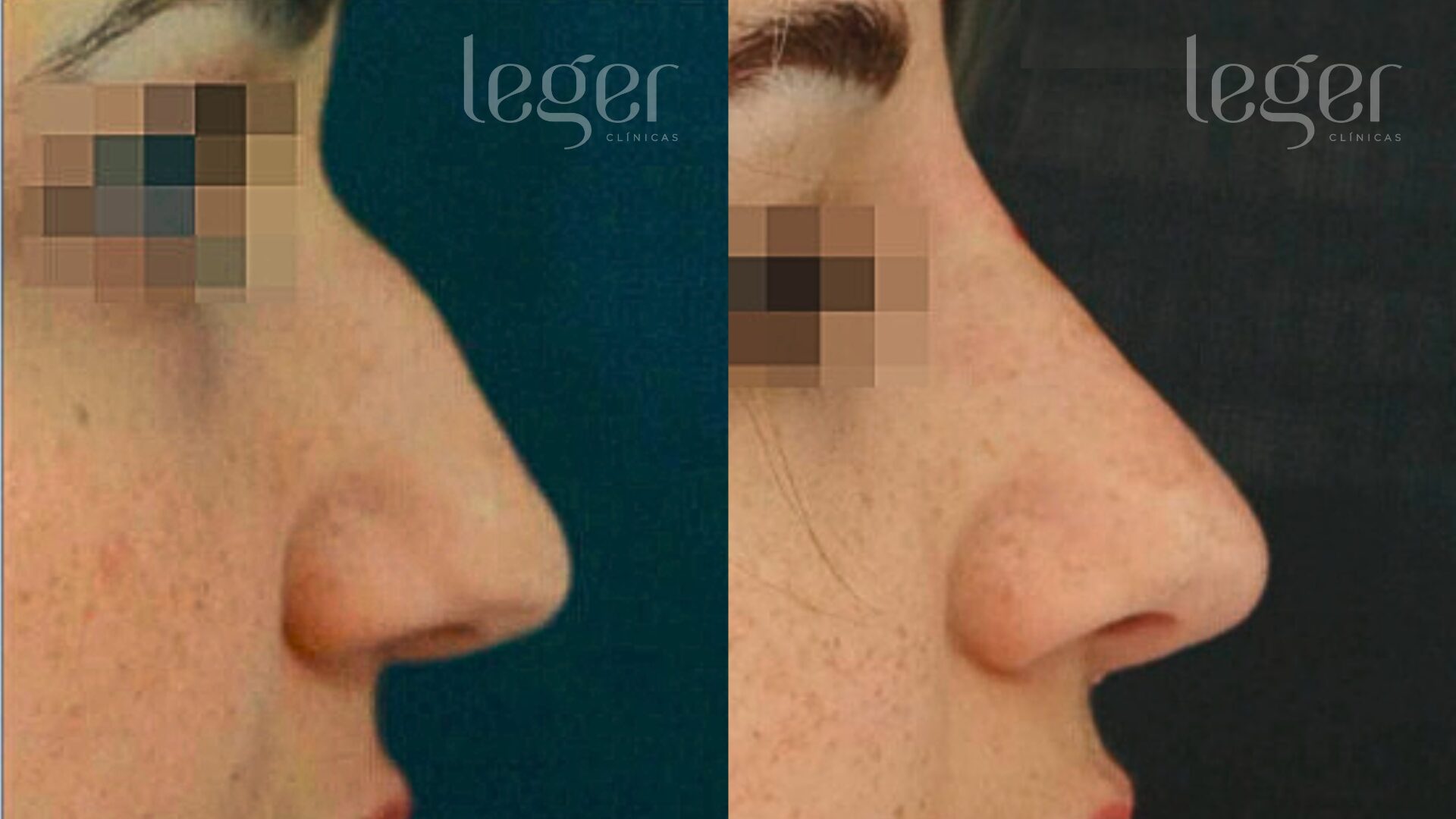 Antes e depois de Rinomodelação para levantamento da ponta nasal - Clínica Leger