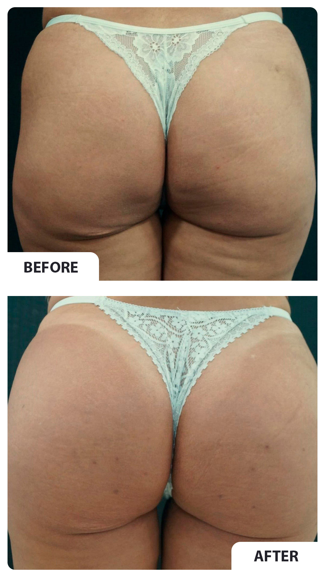 Before and after gluteal harmonization 3