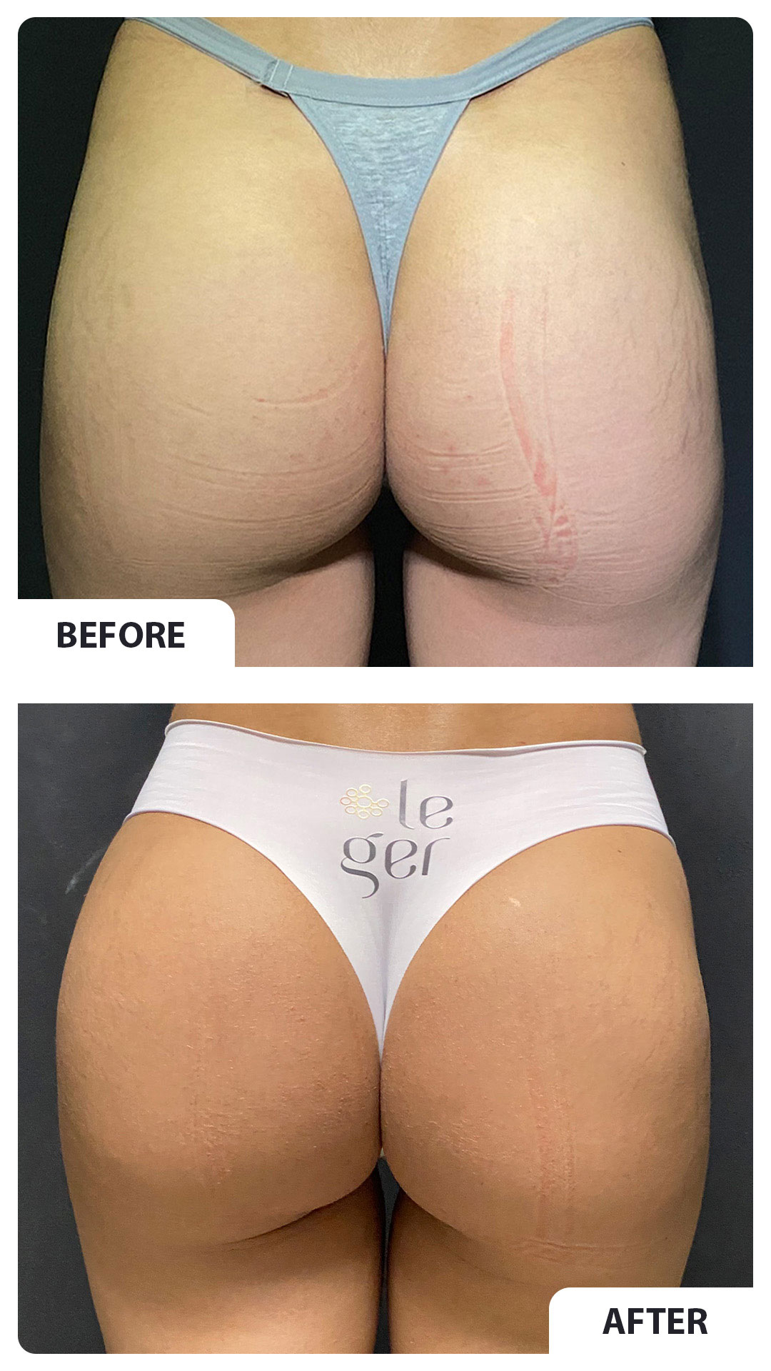 Before and after gluteal harmonization 4