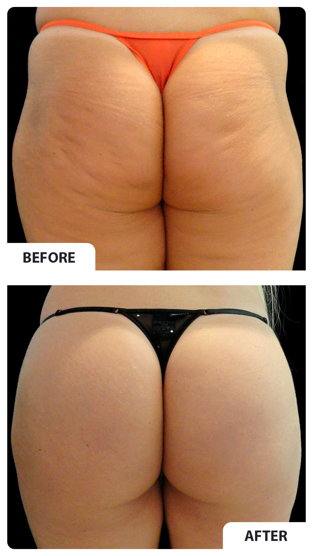 Before and after gluteal harmonization